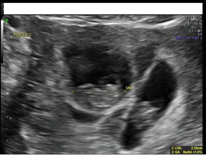 Ultrasound images: Fetal anomalies in multi-fetal gestations