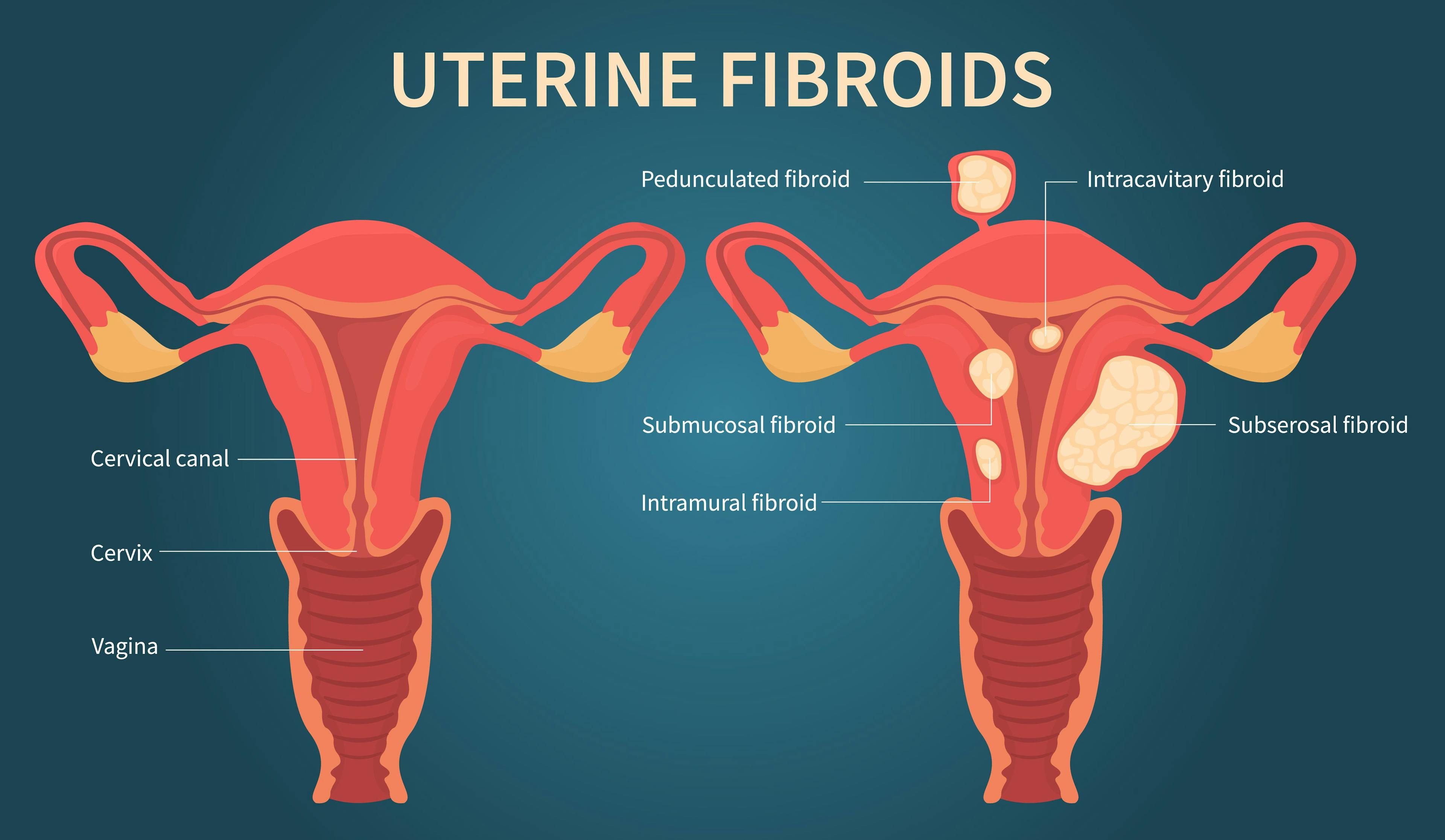 Clinical practice and research yields valuable data for management of uterine fibroids