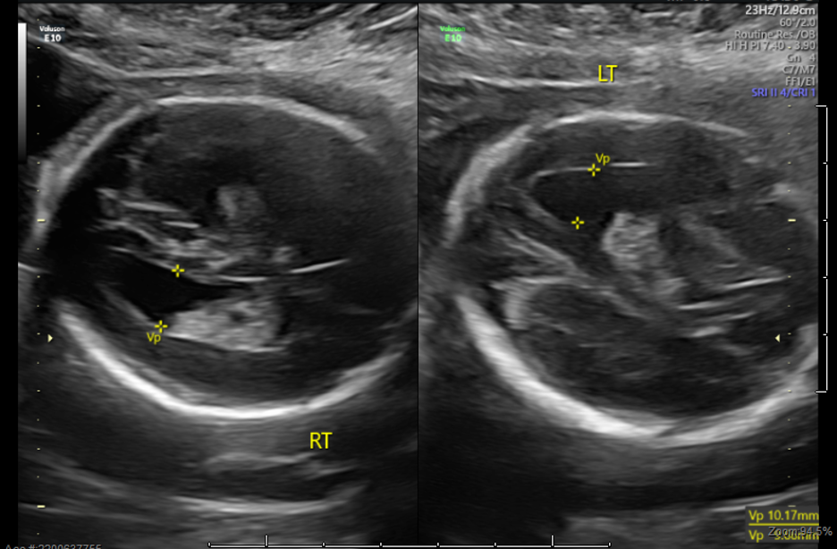 Figure. Mild Bilateral Ventriculomegaly Mild bilateral ventriculomegaly (measuring 10-mm bilaterally) can be seen with congenital cytomegalovirus infection. (Image provided by authors)