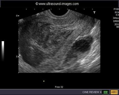 Daily Dx: Pelvic Pain with Discharge