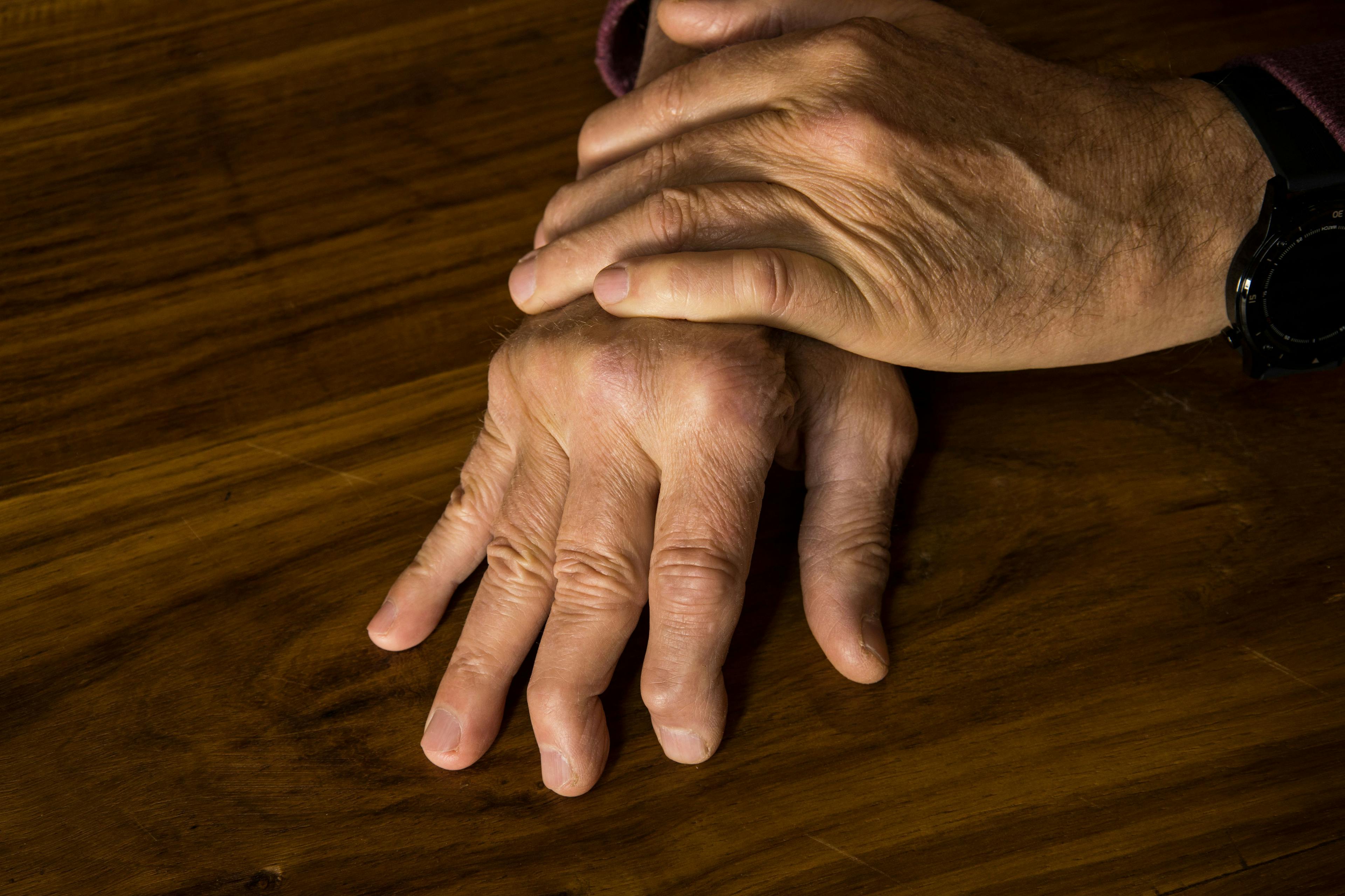 Women report higher psoriatic arthritis burden than men | Image Credit: © Jacques Hugo - © Jacques Hugo - stock.adobe.com.