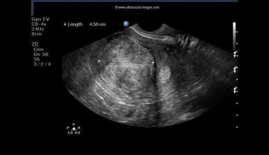 Daily Dx: Polymenorrhea and Pelvic Pain