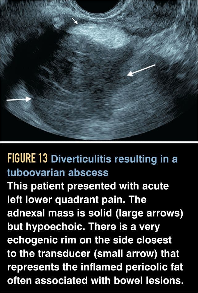 Diverticulitis resulting in a tuboovarian abscess